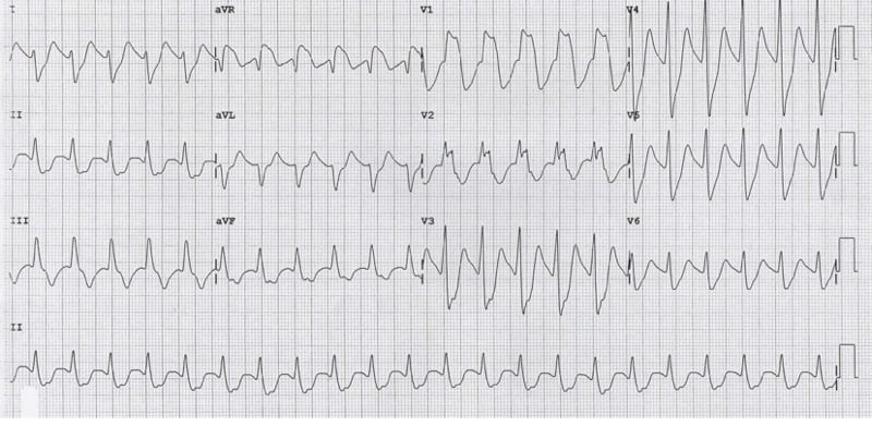 ECG Somnolence broad complex tachycardia